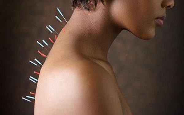 Acupuncture needles in African woman's back